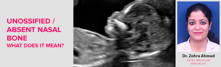 UNOSSIFIED NASAL BONE / ABSENT NASAL BONE IN SCAN – WHAT DOES IT MEAN?