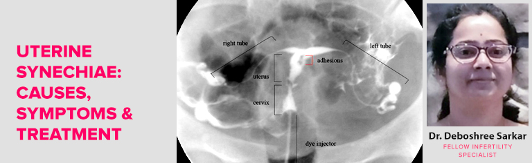 What is Uterine Synechiae? Causes, Symptoms, Diagnosis & Treatment