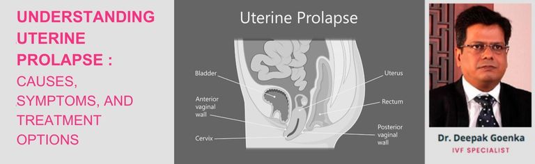 Understanding Uterine Prolapse: Causes, Symptoms, and Treatment Options