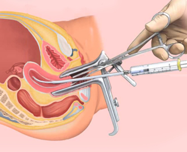 IUI treatment in kolkata